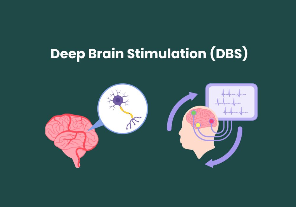 Deep Brain Stimulation (DBS)